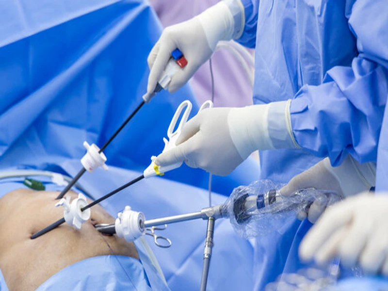  Laparoscopic Surgery for Gallbladder, Renal Stones and Other Surgery